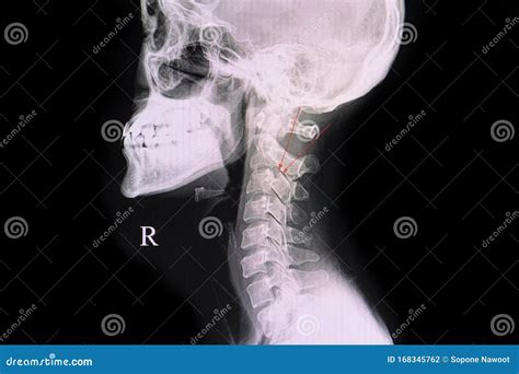 Cervical Pedicle Fracture , Spinal Fractures – PUSHE