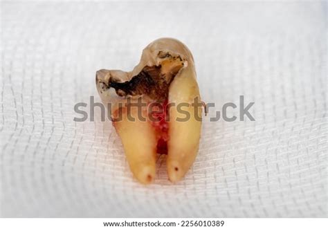 Decayed Tooth Pulling 的图像结果