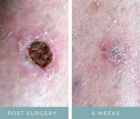 Achieving Healthy Skin After Mohs Surgery