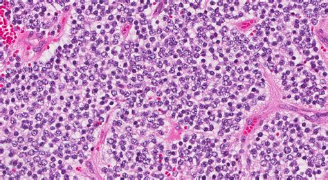 Seu laudo anatomopatológico para neuroblastoma – MyPathologyReport