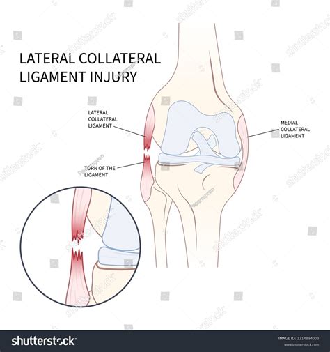 99 Meniscal Injuries Images, Stock Photos & Vectors | Shutterstock
