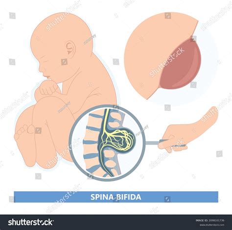 13 Sacral Dimples Newborns Images, Stock Photos & Vectors | Shutterstock