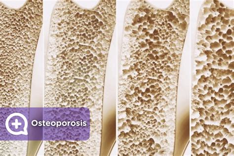 Osteoporosis: causas y tratamientos - mediQuo