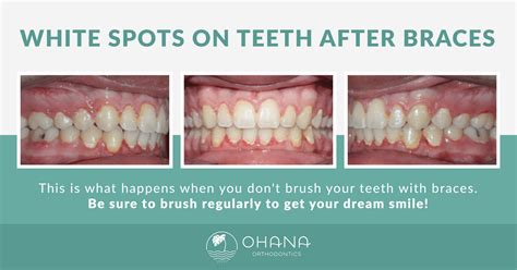Stained Teeth After Braces Treatment