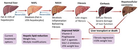 Advances in the Diagnosis and Treatment of Non-Alcoholic Fatty Liver ...