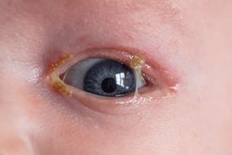 Stringy Eye Discharge