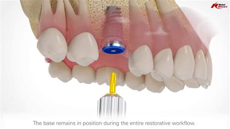 NobelActive 3.0 Dental Implants | Nobel Biocare