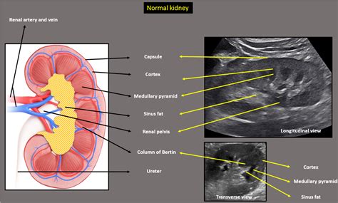 Renal Pyramids Ultrasound