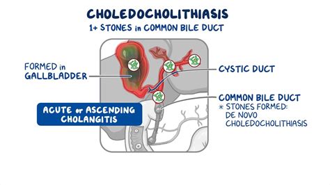 Choledocholithiasis and cholangitis: Clinical sciences - Osmosis Video Library