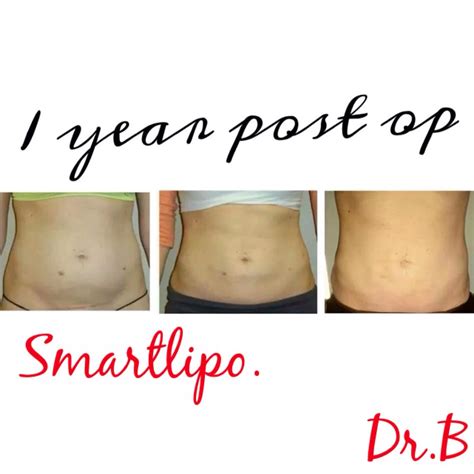 Smart Lipo Before and After 2 Months International Clinics - amtech.blog