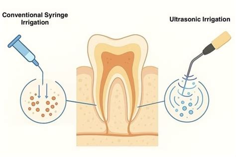 Influence of Ultrasonic Activation of Endodontic Irrigants on Microbial ...
