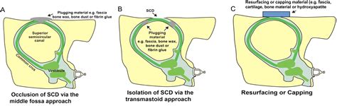 Management of conductive hearing loss of inner ear origin - Operative ...