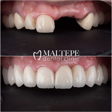Zirconium Dental Crowns: Details, Cost and Procedure [2023] - Maltepe Dental Clinic