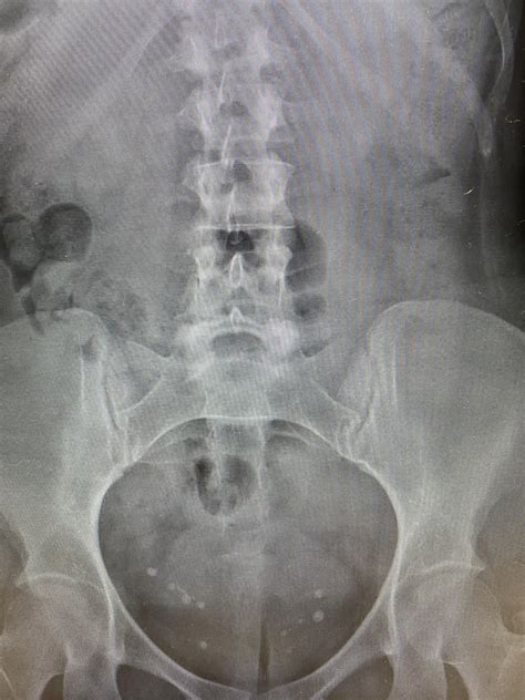 Phleboliths. : r/medizzy