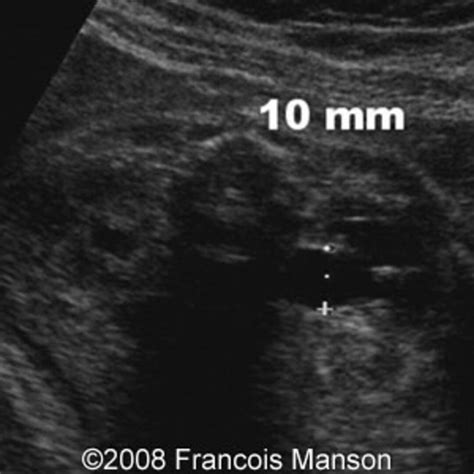 📃 Pyelectasis, unilateral