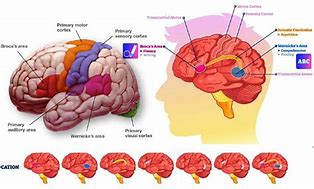 Image result for aphasia