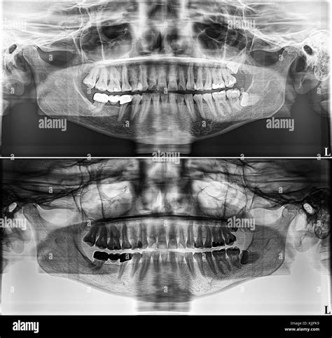 Panoramic Dental X Ray Images Panoramic Dental X Ray In Dubai, Abu