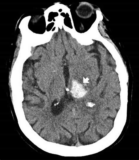 Brain hemorrhage causes, types, symptoms, diagnosis & treatment