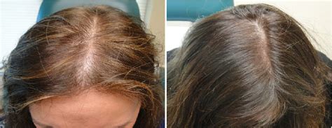 Hair Fall,Hair Loss,Male Baldness Treatment Doctor Hospital Clinic in ...