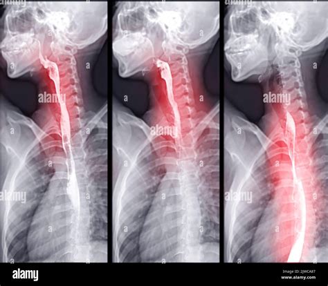 Barium Swallow study test diagnose Barrett's GI tract exam GERD ulcers ...