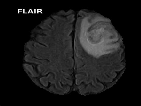 RadGLO-Radiology of Glioma