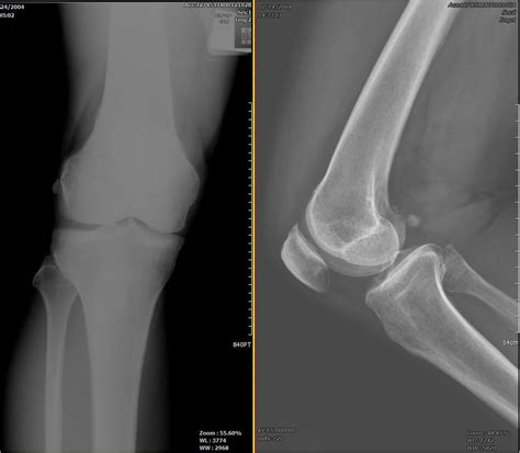 Os Fabella - WikiSM (Sports Medicine Wiki)