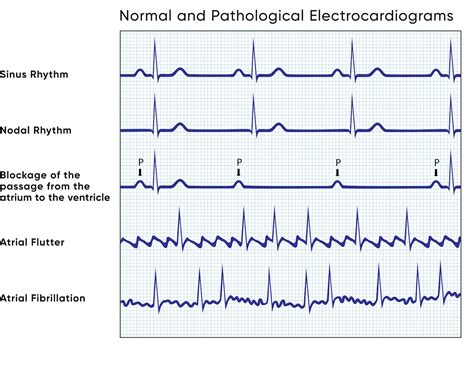Electrocardiography Of Arrhythmias