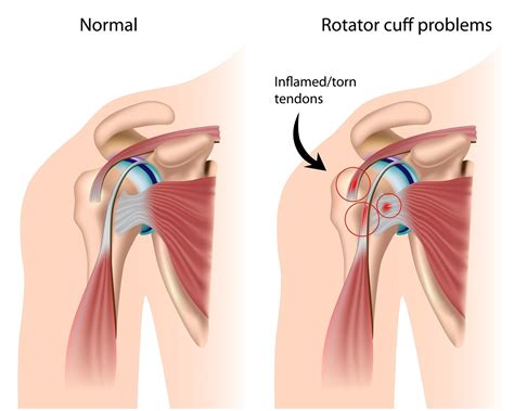Shoulder Impingement Syndrome - BodyChek