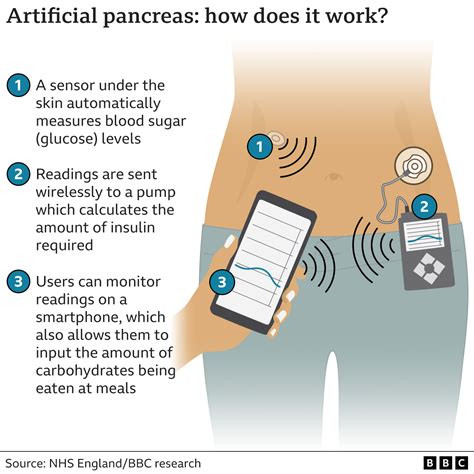 Diabetes artificial pancreas tech recommended for thousands on NHS ...
