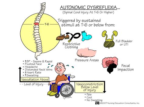 Nursing Mnemonics and Tips: Autonomic Dysreflexia | Nursing mnemonics, Medical surgical nursing ...