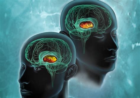 Image result for Exploding Head Syndrome While Awake