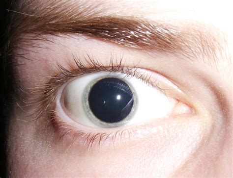 Mydriasis - Wikipedia