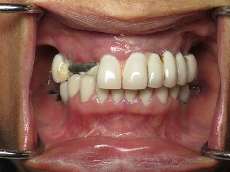 Broken All On 4 Dental Implant Bridges