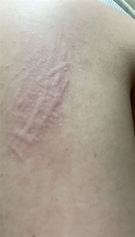 r/Dermatographia