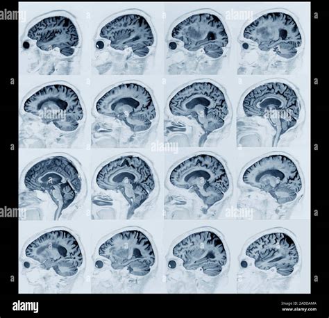Alzheimers Disease Mri