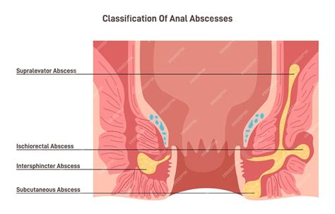 Premium Vector | Anal abscess Perianal abscess lump filled with pus found near the anus