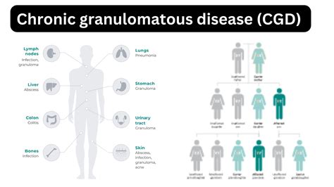 Chronic Granulomatous Disease