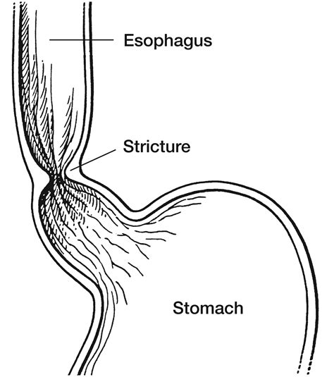Z Line Esophagus Endoscopic Evaluation Of The Esophagus And Endoscopic