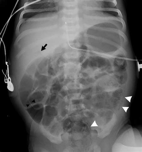 Rumbly in the tumbly: Pneumatosis intestinalis and necrotizing enterocolitis | Radiology Key