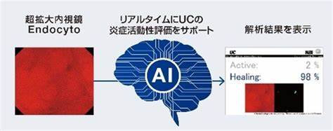 国内初の薬事承認を取得した潰瘍性大腸炎評価用AI技術 AIを搭載した内視鏡画像診断支援ソフトウェア「EndoBRAIN-UC」を発売 大腸 ...