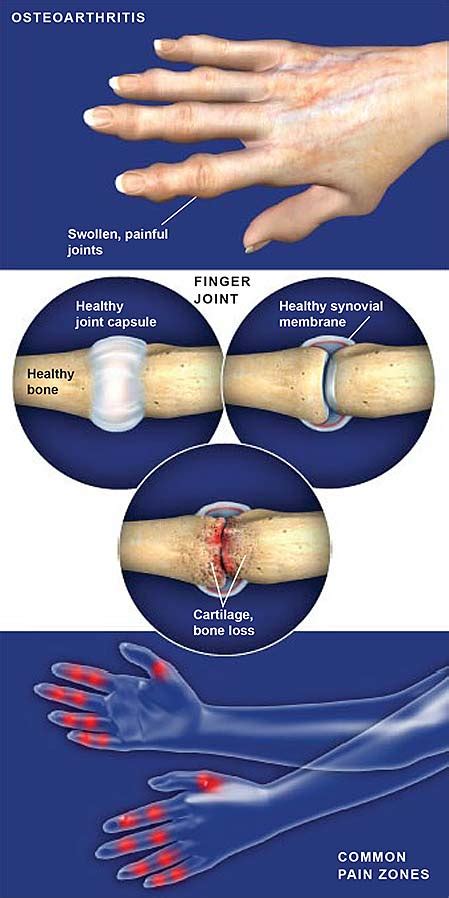 Osteoarthritis of the Hand | Central Coast Orthopedic Medical Group