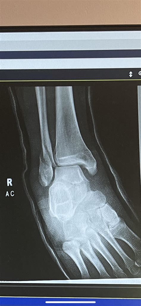 Broken Fibula Recovery Time