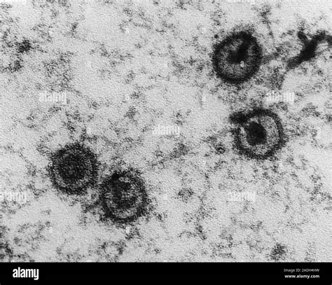 Epstein-Barr viruses, EBV. Transmission electron micrograph of Epstein-Barr viruses in Burkitt's ...