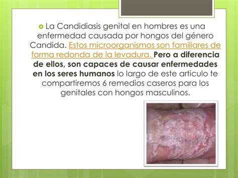 Candidiasis En Hombres