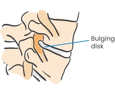 Bulging Disc Example 的图像结果