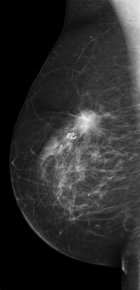 Imaging evaluation of nipple discharge: Review of literature and ...
