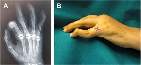 Image result for Hand Dysfunction