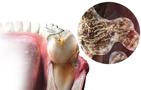 Dental Biofilm Formation at Pamela Walsh blog