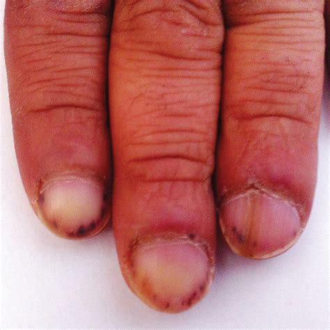 Hemorrhagic Splinters In Nails