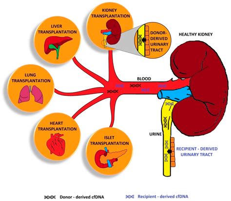 Process Of Kidney Transplant